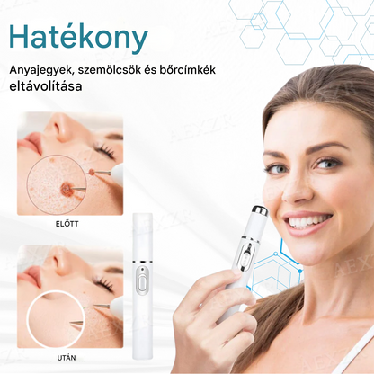 ✅✅✅Bikenda® non-invazív anyajegy- és szemölcseltávolító lézertoll