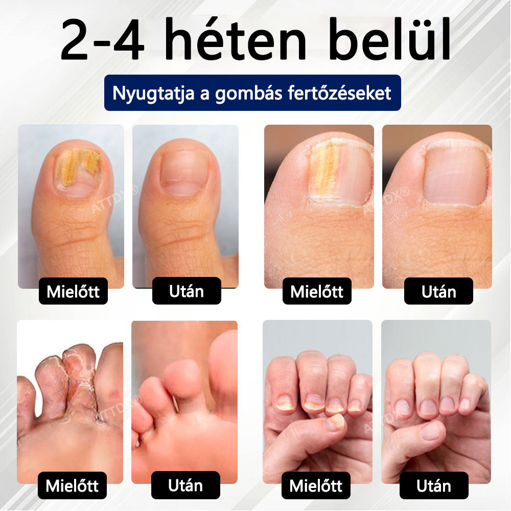 Croaie® Fungiclear Bee Therapy Nail Spray🎁🎁