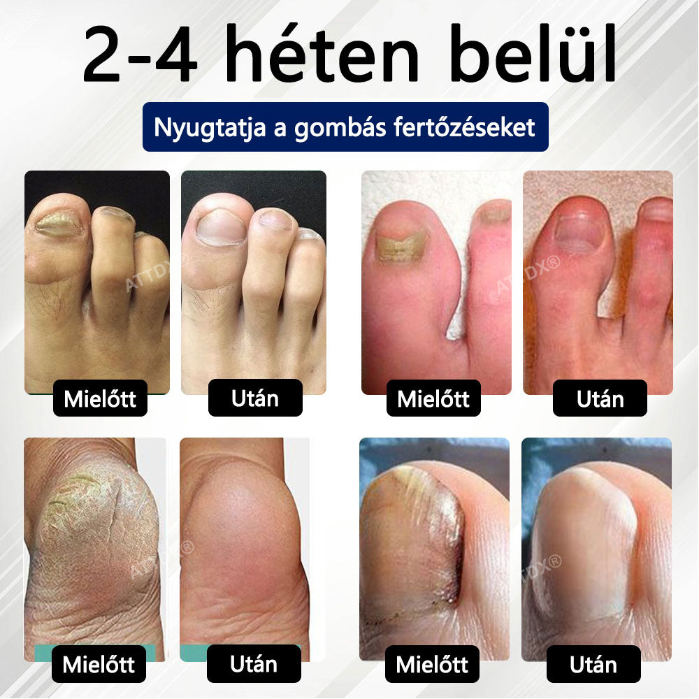 Croaie® Fungiclear Bee Therapy Nail Spray🎁🎁